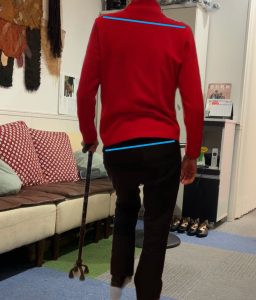 脚長差による歩行時の肩・骨盤の傾き（調整前・杖使用）