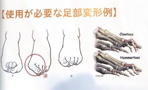 外反母趾・ハンマートゥ・クロウトゥなど複雑な足趾変形にも対応できるオトーゼの考え方を示した図